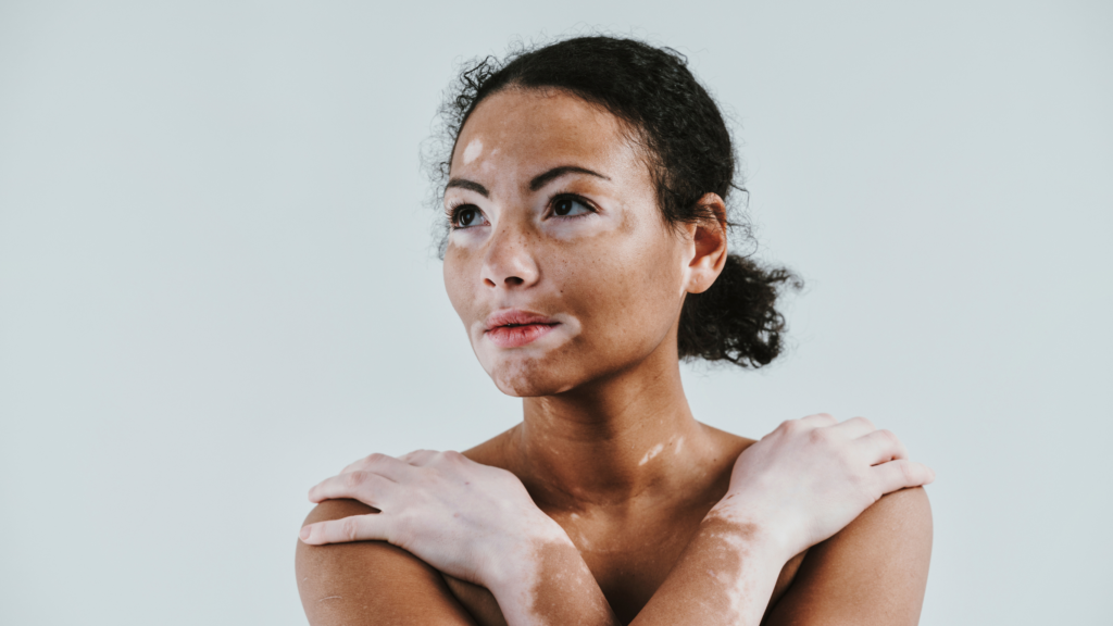 Patchy Loss of Skin Color