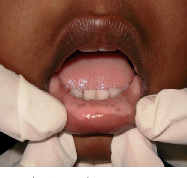 Loss of Color in Mucous Membranes