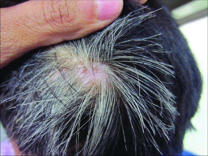 Premature Graying of Hair